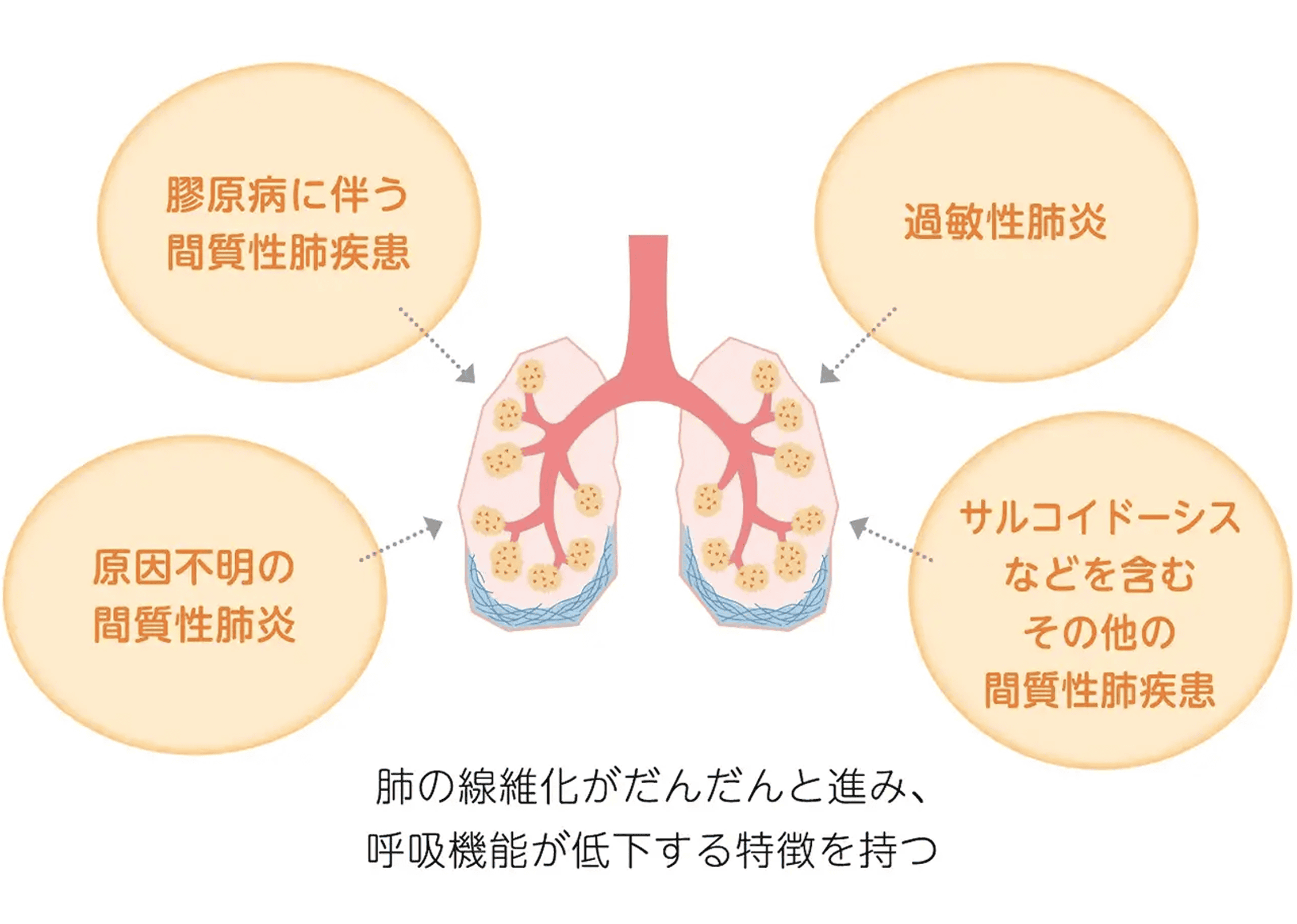 間 質 性 肺炎 症状