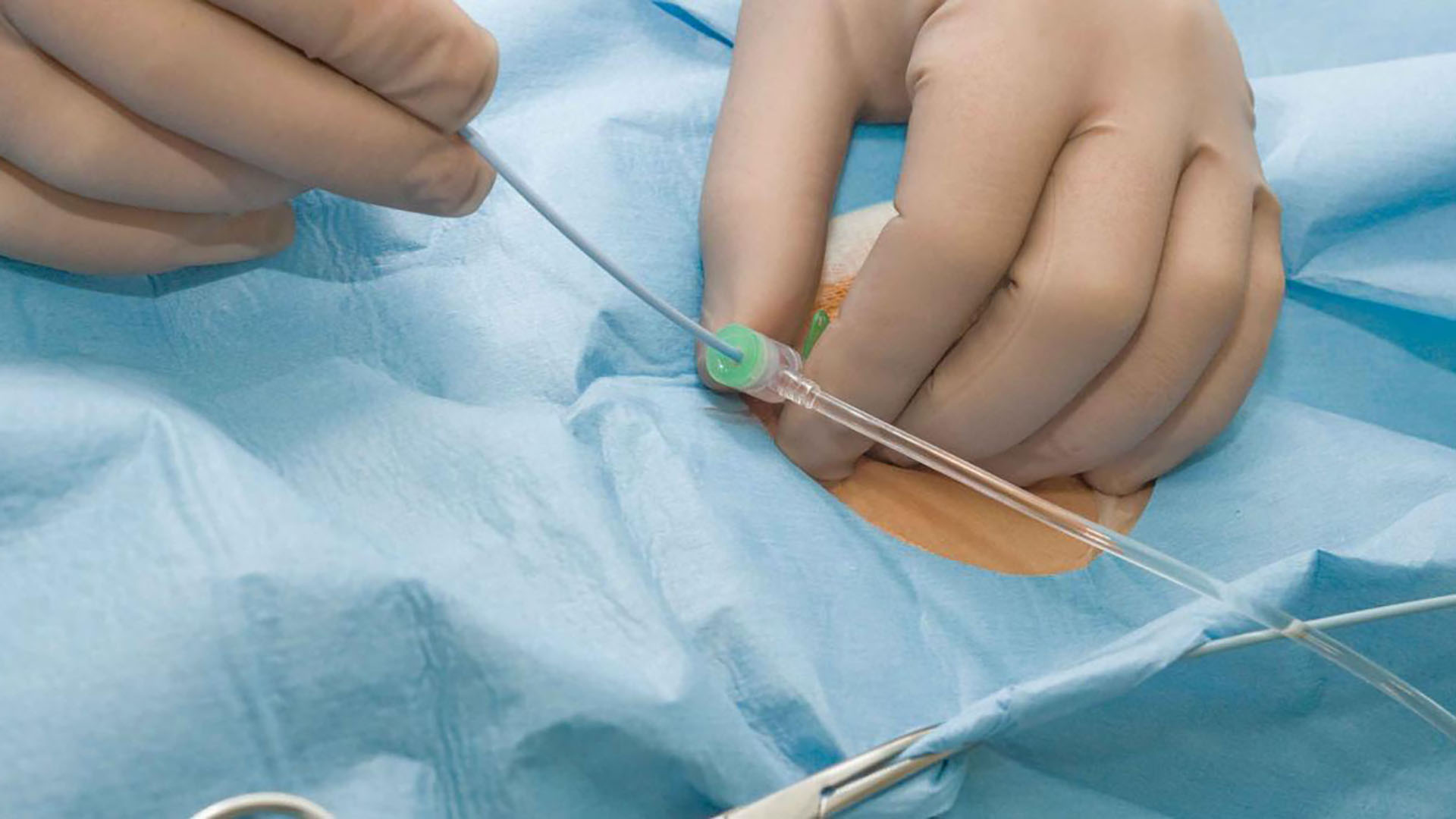 Cardiac catheterisation procedure | More Than Scleroderma