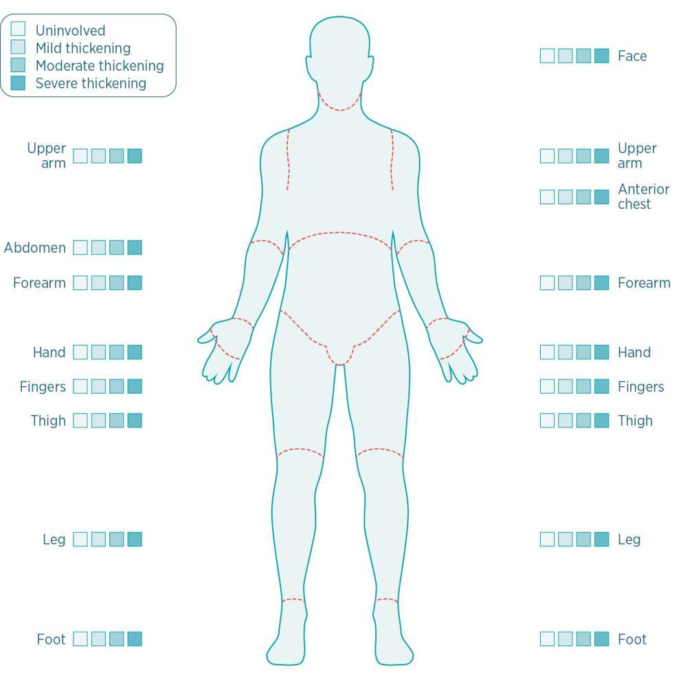 skin-thickening-test-more-than-scleroderma