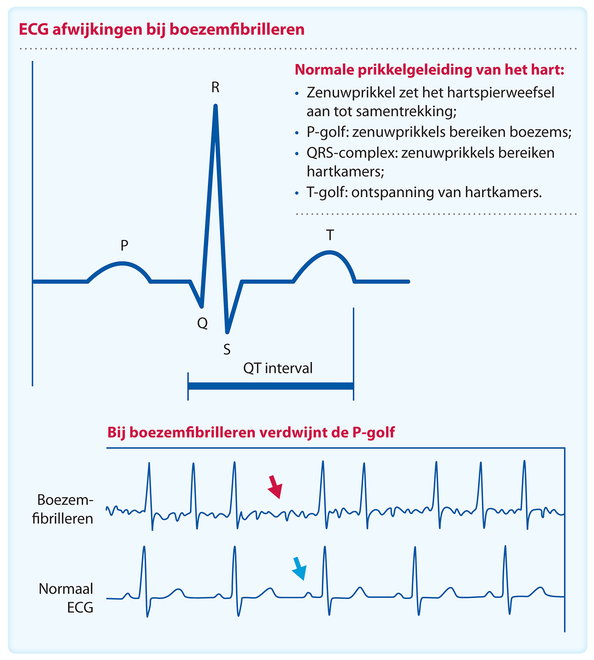 Hartprobleem boezemfibrilleren Boezemfibrilleren