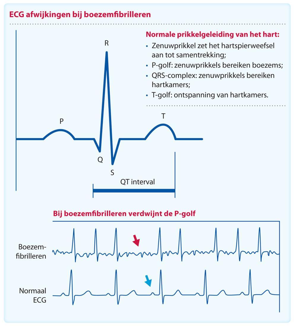 Hartprobleem Boezemfibrilleren | Boezemfibrilleren