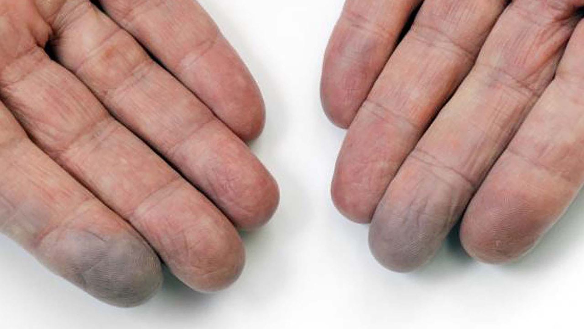 S ntomas De La Esclerodermia M s Que Esclerodermia
