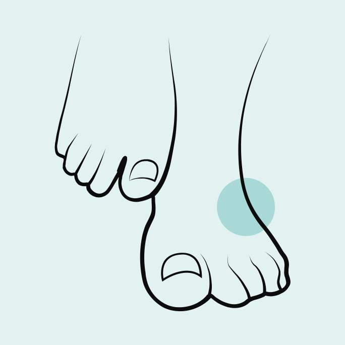 Symtom systemisk skleros More Than Scleroderma