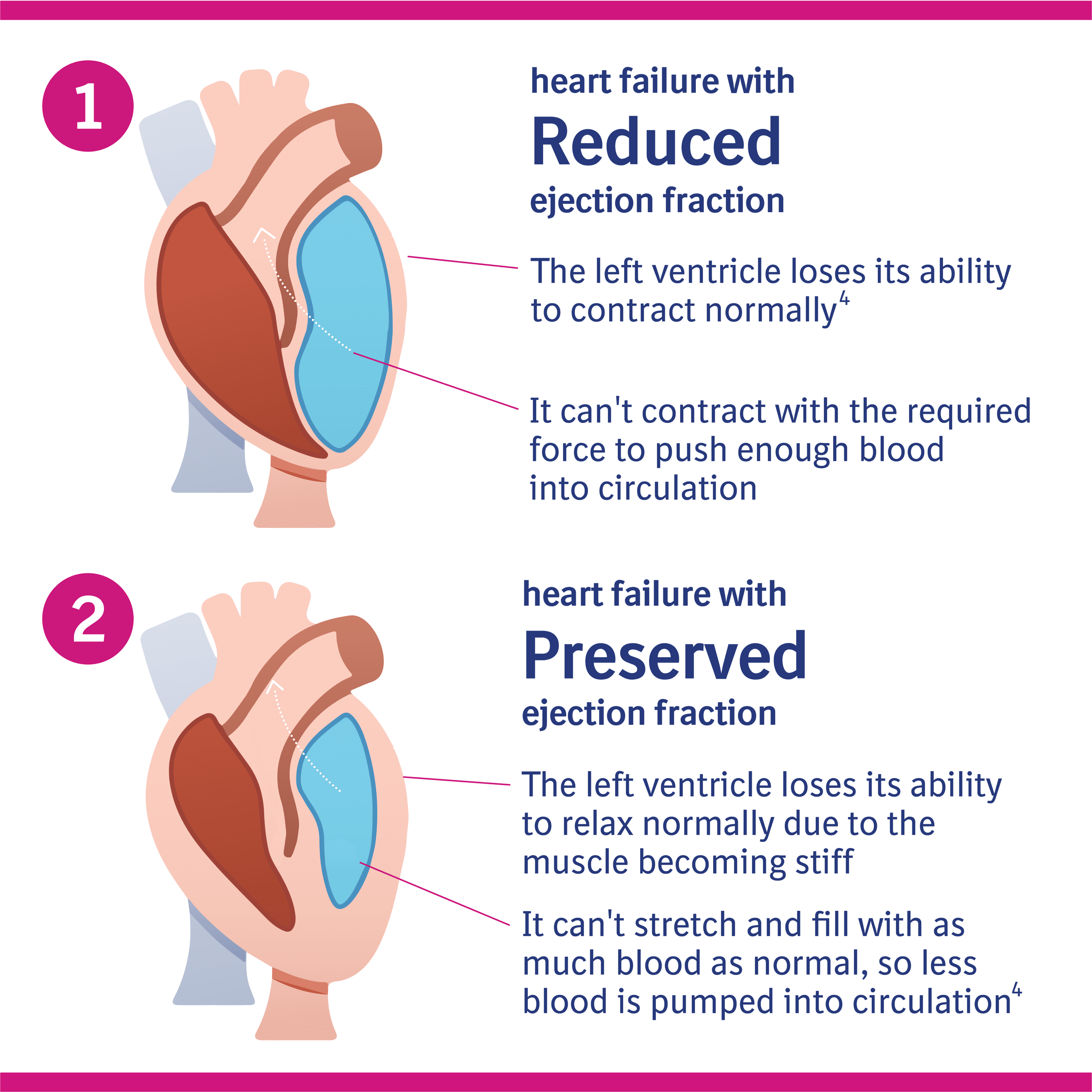 About heart failure Your Health Hub